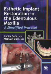 Esthetic Implant Restoration in the Edentulous Maxilla - A Simplified Protocol