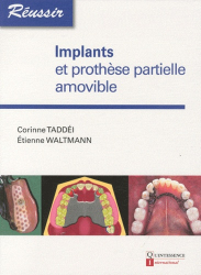 Implants et prothèse partielle amovible