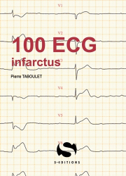 100 ECG autour de l'infarctus