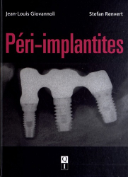 Vous recherchez des promotions en Dentaire, Péri-implantites