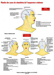 Planche des zones de stimulation de l'acupuncture crânienne